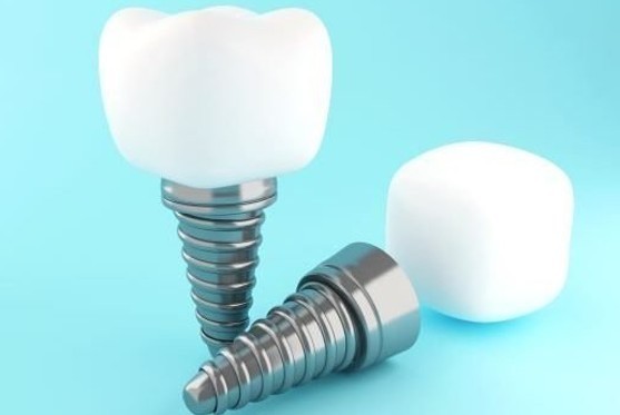 Things to Consider When Choosing a Dentist for Implant